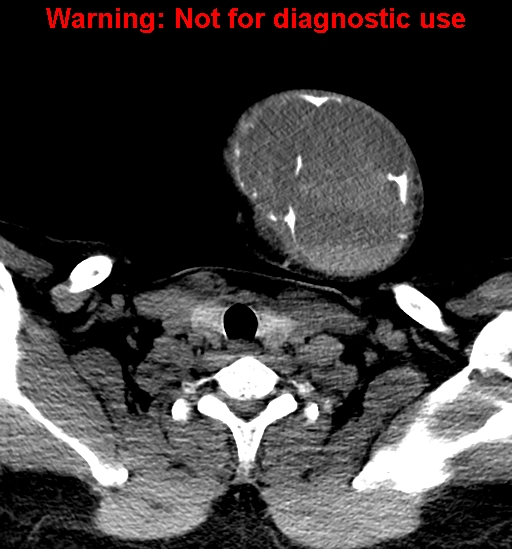 File:Ameloblastoma (Radiopaedia 33126-34164 A 35).jpg