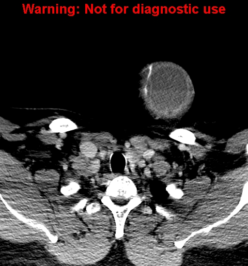 File:Ameloblastoma (Radiopaedia 33126-34164 B 41).jpg