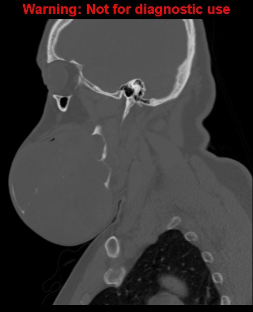 Ameloblastoma (Radiopaedia 33126-34164 Sagittal bone window 26).jpg