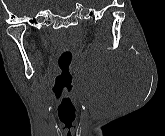 Ameloblastoma (Radiopaedia 51921-57766 Coronal bone window 177).jpg