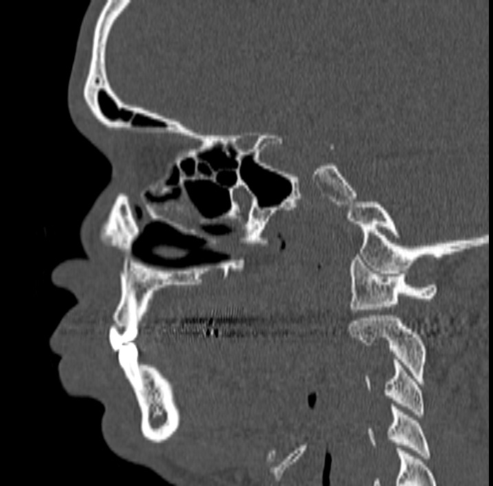 Ameloblastoma (Radiopaedia 77750-89997 Sagittal bone window 10).jpg