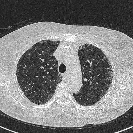 Amiodarone-induced pulmonary fibrosis (Radiopaedia 82355-96460 Axial lung window 22).jpg