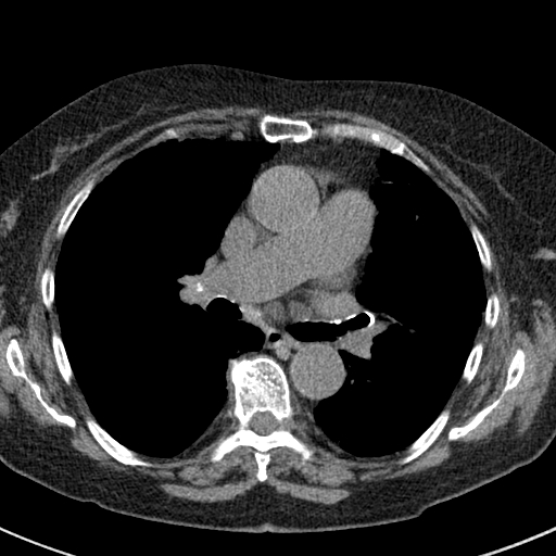 File:Amiodarone-induced pulmonary fibrosis (Radiopaedia 82355-96460 Axial non-contrast 30).jpg