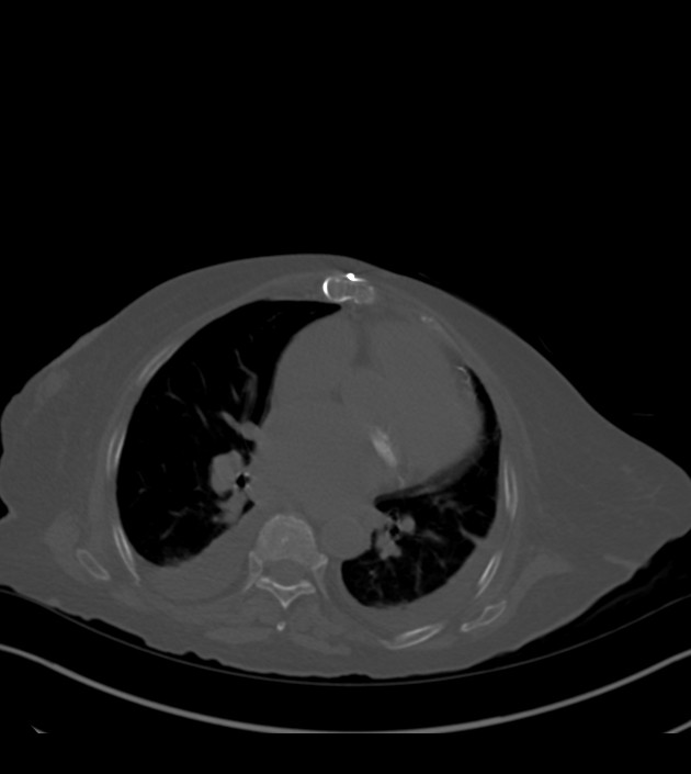 Amiodarone deposition in the liver (Radiopaedia 77587-89780 Axial bone window 46).jpg