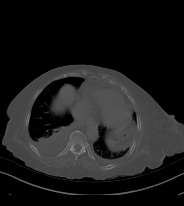 Amiodarone deposition in the liver (Radiopaedia 77587-89780 Axial bone window 64).jpg