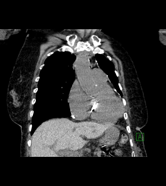 Amiodarone deposition in the liver (Radiopaedia 77587-89780 Coronal non-contrast 29).jpg