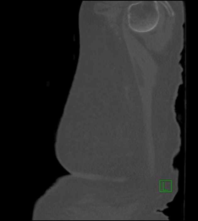 Amiodarone deposition in the liver (Radiopaedia 77587-89780 Sagittal bone window 8).jpg
