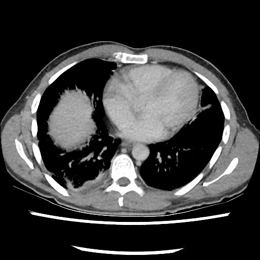 Amoebic liver abscesses (Radiopaedia 55536-62010 A 6).jpg