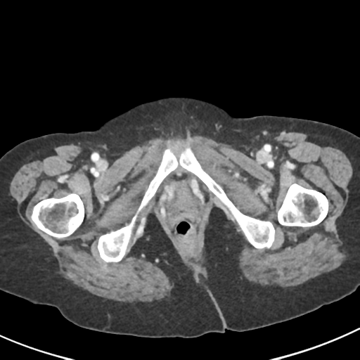 Ampullary adenocarcinoma (Radiopaedia 34013-35237 C 61).png