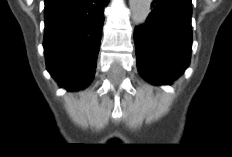 Ampullary adenocarcinoma (Radiopaedia 34013-35241 Coronal 45).png