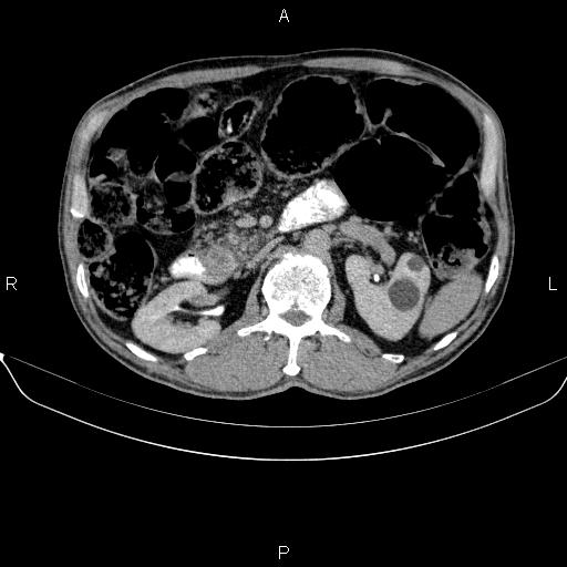 Ampullary adenocarcinoma (Radiopaedia 86093-102032 Axial C+ delayed 41).jpg