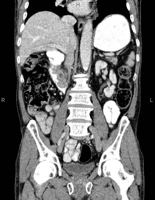 Ampullary adenocarcinoma (Radiopaedia 86093-102032 C 38).jpg