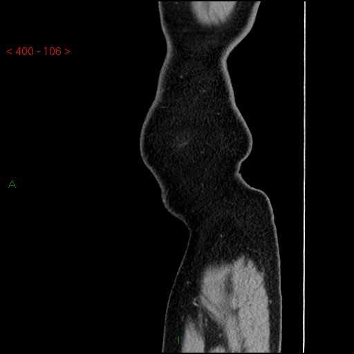 File:Ampullary carcinoma (Radiopaedia 56396-63056 D 105).jpg
