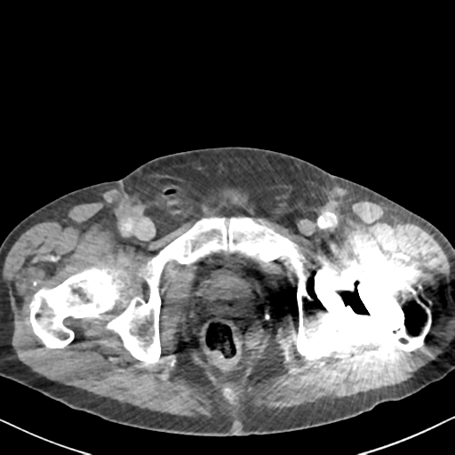File:Amyand hernia (Radiopaedia 39300-41547 A 72).png
