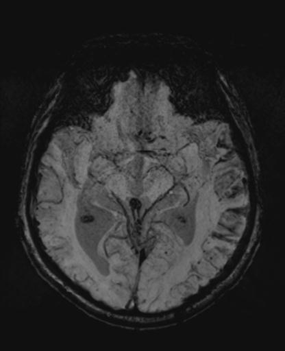 File:Amyloid angiopathy with inflammation (Radiopaedia 30360-31002 Axial SWI MIP 22).jpg