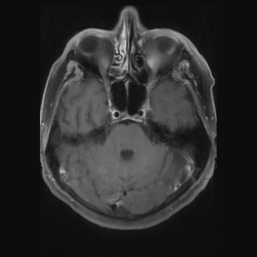 File:Amyloid angiopathy with inflammation (Radiopaedia 30360-31002 Axial T1 C+ fat sat 9).jpg