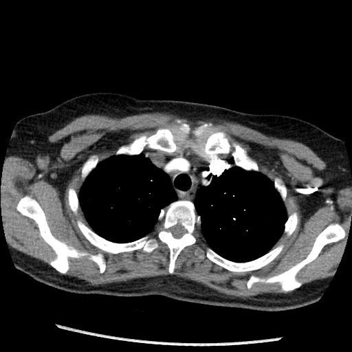 File:Amyloidosis - bronchial and diffuse nodular pulmonary involvement (Radiopaedia 60156-67745 A 9).jpg