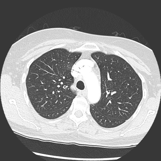 Amyloidosis - bronchial and diffuse nodular pulmonary involvement (Radiopaedia 60156-67745 Axial lung window 22).jpg