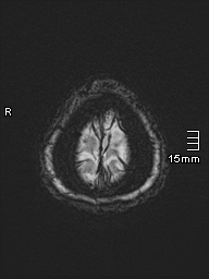 File:Amyotrophic lateral sclerosis (Radiopaedia 70821-81017 Axial SWI 1).jpg