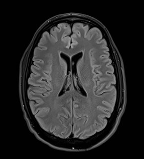 File:Amyotrophic lateral sclerosis (Radiopaedia 87352-103658 Axial FLAIR 18).jpg