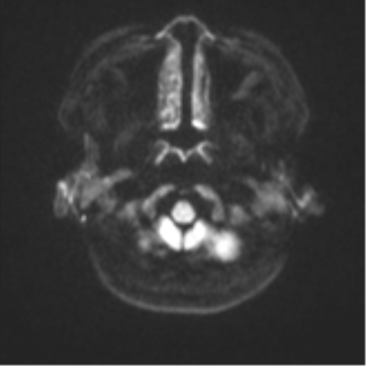 Anaplastic astroblastoma (Radiopaedia 55666-62194 Axial DWI 31).png