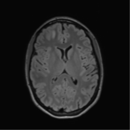 File:Anaplastic astrocytoma IDH mutant (Radiopaedia 50046-55341 Axial FLAIR 28).png