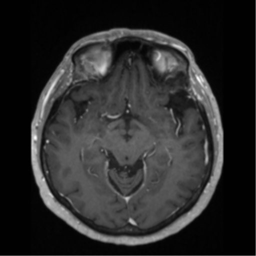 File:Anaplastic astrocytoma IDH wild-type (pseudoprogression) (Radiopaedia 42209-45276 Axial T1 C+ 66).png
