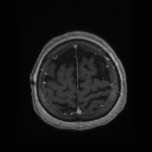 Anaplastic astrocytoma IDH wild-type (pseudoprogression) (Radiopaedia 42209-45277 Axial T1 C+ 110).png
