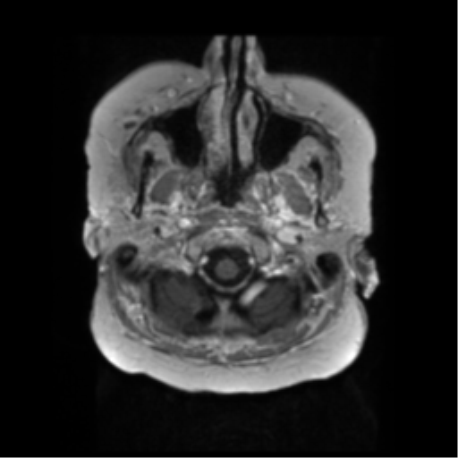 File:Anaplastic astrocytoma IDH wild-type (pseudoprogression) (Radiopaedia 42209-45279 Axial T1 C+ 13).png