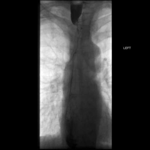 File:Anastomotic stricture post Ivor Lewis esophagectomy (Radiopaedia 47937-52715 B 29).png