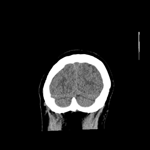 File:Aneursym related subarachnoid hemorrhage with hydrocephalus (Radiopaedia 45105-49083 Coronal non-contrast 61).jpg