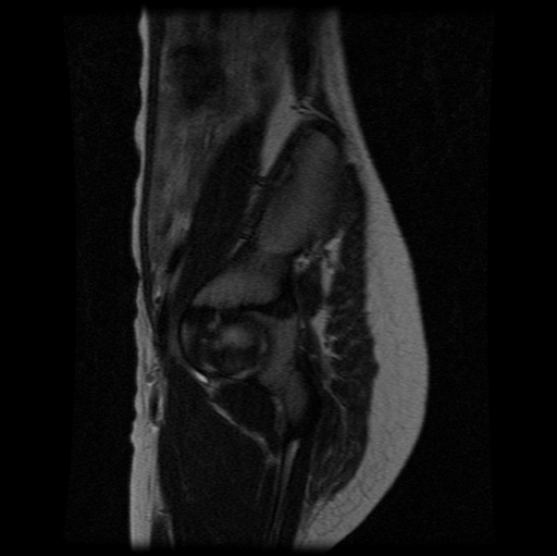File:Aneurysmal bone cyst - sacrum (Radiopaedia 65190-74196 Sagittal T2 8).jpg