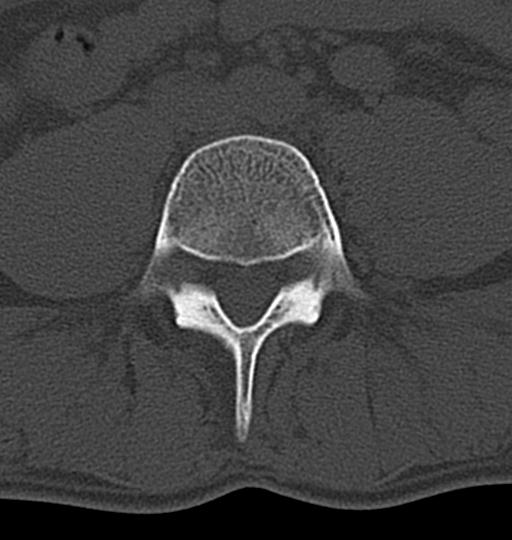 Aneurysmal bone cyst T11 (Radiopaedia 29294-29721 Axial bone window 101).jpg