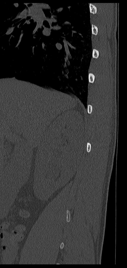 Aneurysmal bone cyst T11 (Radiopaedia 29294-29721 Sagittal bone window 73).jpg