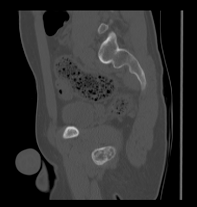 Aneurysmal bone cyst of ischium (Radiopaedia 25957-26094 Sagittal bone window 45).png