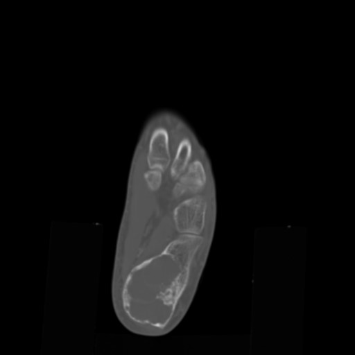 File:Aneurysmal bone cyst of the calcaneus (Radiopaedia 60669-68421 Axial bone window 13).jpg