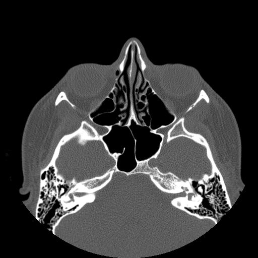 Aneurysmal bone cyst of the mandible (Radiopaedia 43280-46823 Axial bone window 157).jpg