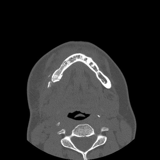 Aneurysmal bone cyst of the mandible (Radiopaedia 43280-46823 Axial bone window 33).jpg
