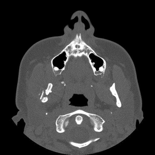 Aneurysmal bone cyst of the mandible (Radiopaedia 43280-46823 Axial bone window 99).jpg