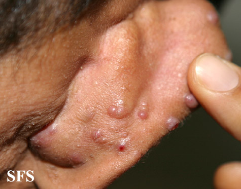Angiolymphoid Hyperplasia With Eosinophilia (Dermatology Atlas 10).jpg