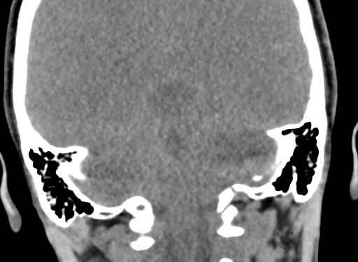Angular dermoid cyst (Radiopaedia 88967-105790 Coronal non-contrast 89).jpg
