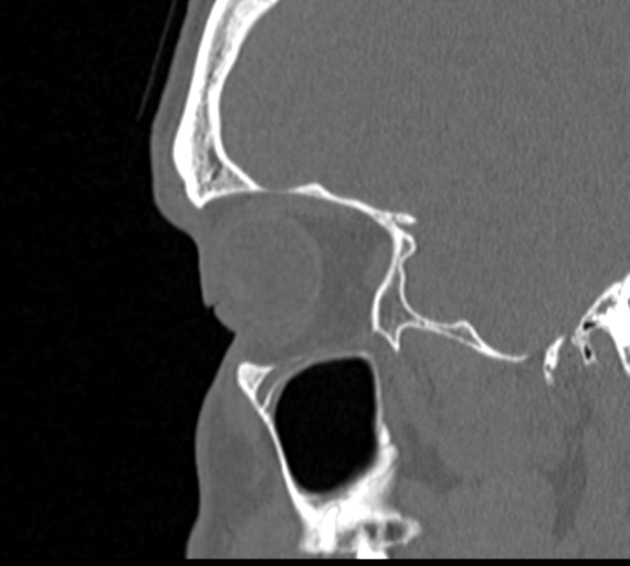 Angular epidermoid cyst (Radiopaedia 46908-51439 Sagittal bone window 14).png