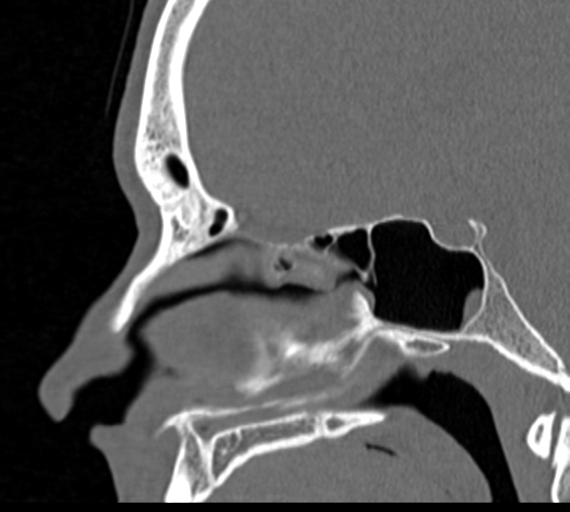 Angular epidermoid cyst (Radiopaedia 46908-51439 Sagittal bone window 41).png