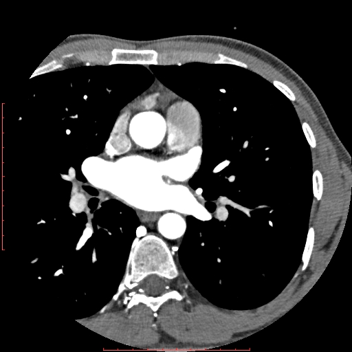 Anomalous left coronary artery from the pulmonary artery (ALCAPA) (Radiopaedia 70148-80181 A 62).jpg