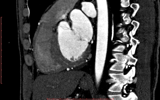 File:Anomalous left coronary artery from the pulmonary artery (ALCAPA) (Radiopaedia 70148-80181 C 141).jpg