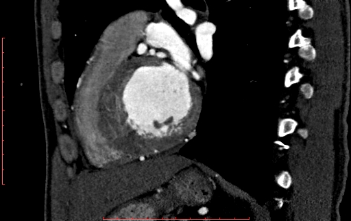 Anomalous left coronary artery from the pulmonary artery (ALCAPA) (Radiopaedia 70148-80181 C 163).jpg
