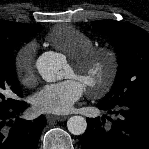 File:Anomalous origin of the left coronary artery with malignant course (Radiopaedia 77842-90126 C 89).jpeg