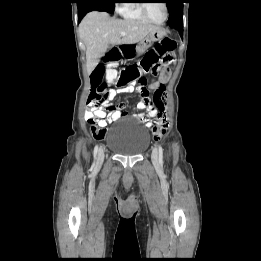 Anorectal carcinoma (Radiopaedia 44413-48064 B 12).jpg