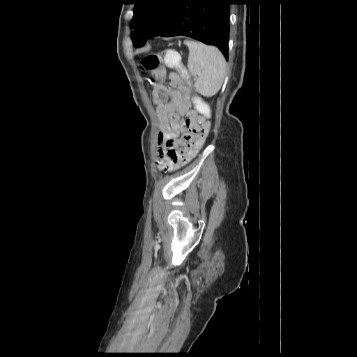 Anorectal carcinoma (Radiopaedia 44413-48064 C 96).jpg