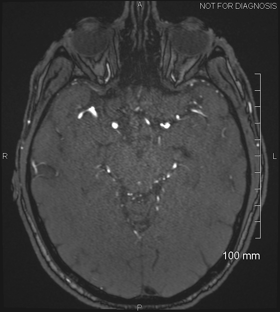 Anterior cerebral artery aneurysm (Radiopaedia 80683-94127 Axial MRA 100).jpg